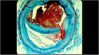 OCT-NIRS Imaging for Detection of Coronary Plaque Structure and Vulnerability